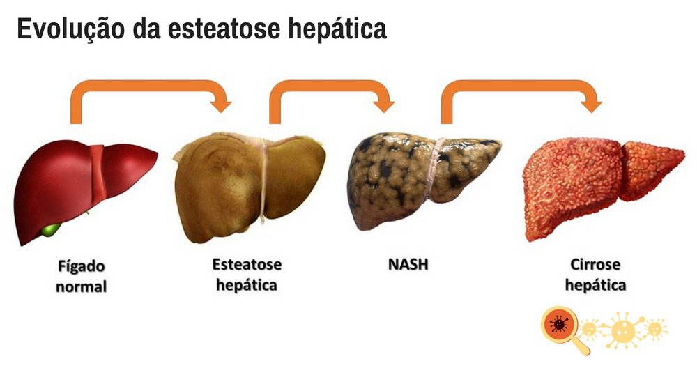 Evolução Da Esteatose Hepática