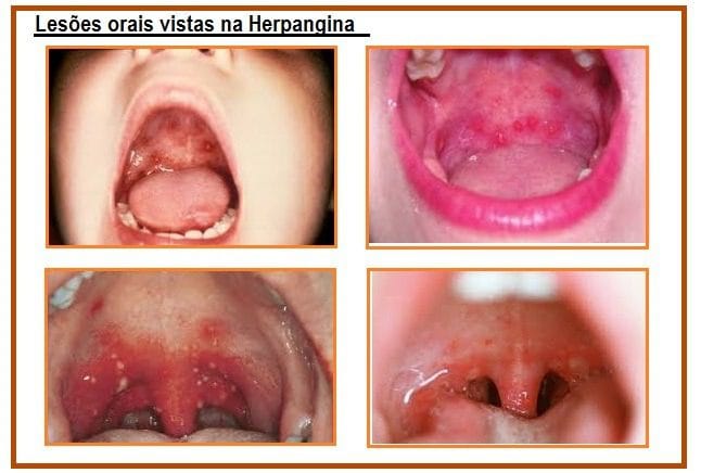 Herpangina: o que é, sintomas e tratamento - Tua Saúde