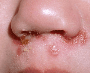 Impetigo