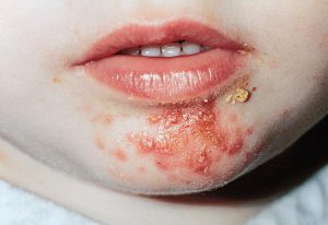 Impetigo não Bolhoso