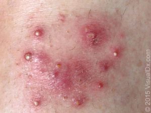 Foliculite por dermatophyte - Majocchi's granuloma Foliculite por dermatophyte - Majocchi's granuloma