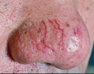 Rosácea com telangiectasia Rosácea com telangiectasia
