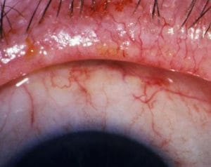 Rosácea ocular Rosácea ocular