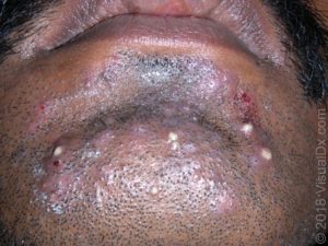 https://www.uptodate.com/contents/images/DERM/117243/Tineabarbae3.jpg Foliculite por fungo - tinea barbae