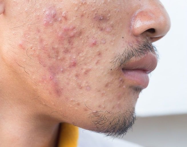 Infecção de pele