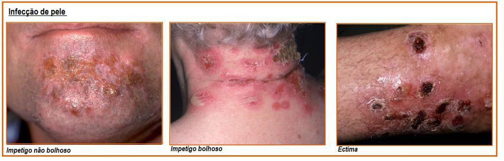 Infecções de pele Impetigo