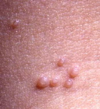 Molusco Contagioso