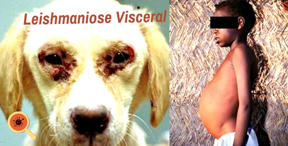 Infectologista - Leishmaniose Visceral Infectologista - Leishmaniose Visceral