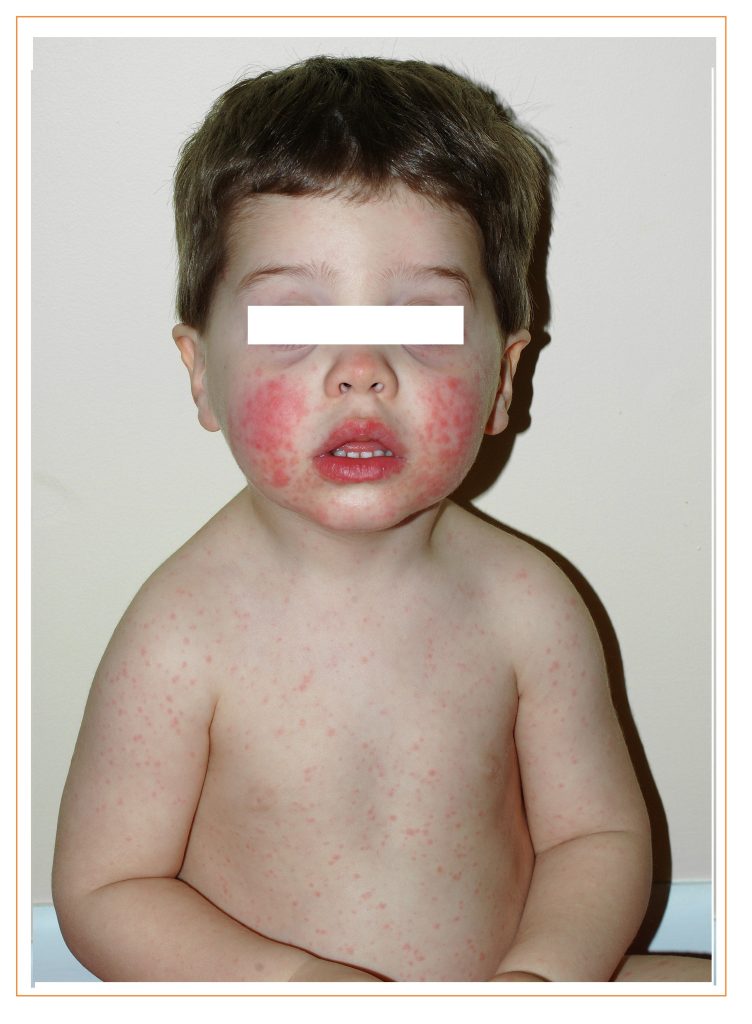 Eritema Infeccioso parvovirus B 19
