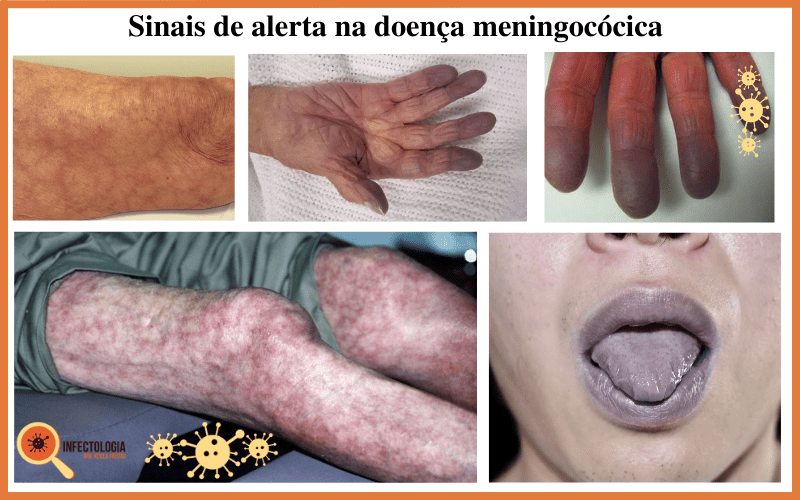 Infecção Meningocócica - Saiba Mais