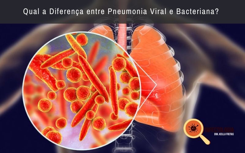 Qual a Diferença entre Pneumonia Viral e Bacteriana?