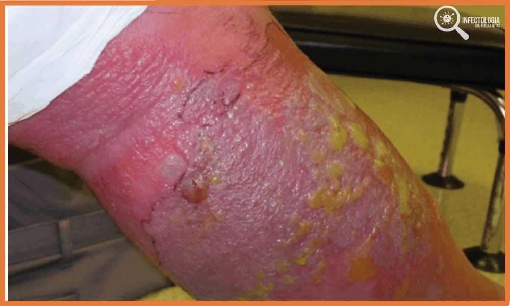 Erisipela ou Celulite Infecciosa: Conheça A Doença