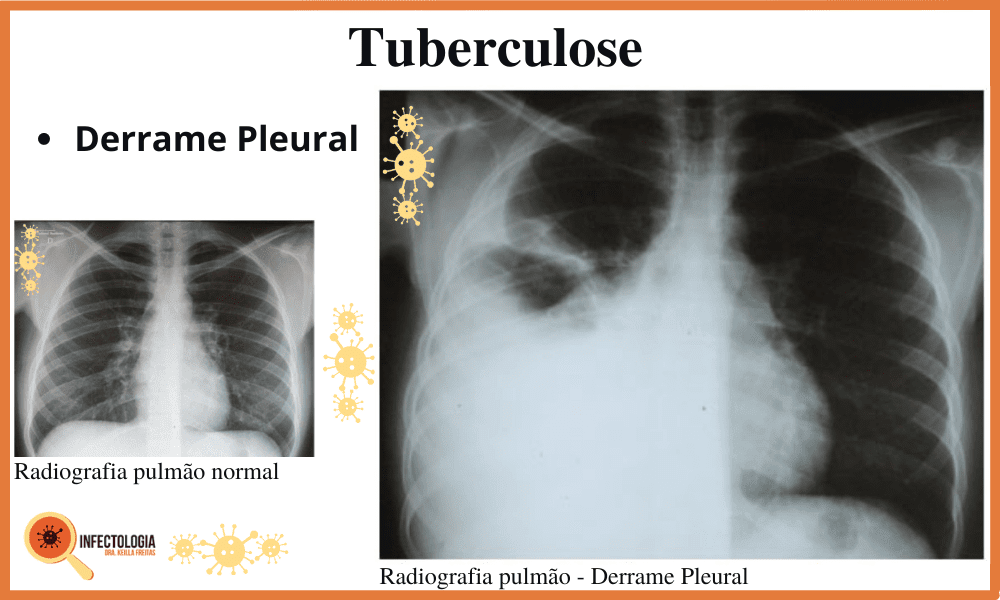 Sintomas da Tuberculose