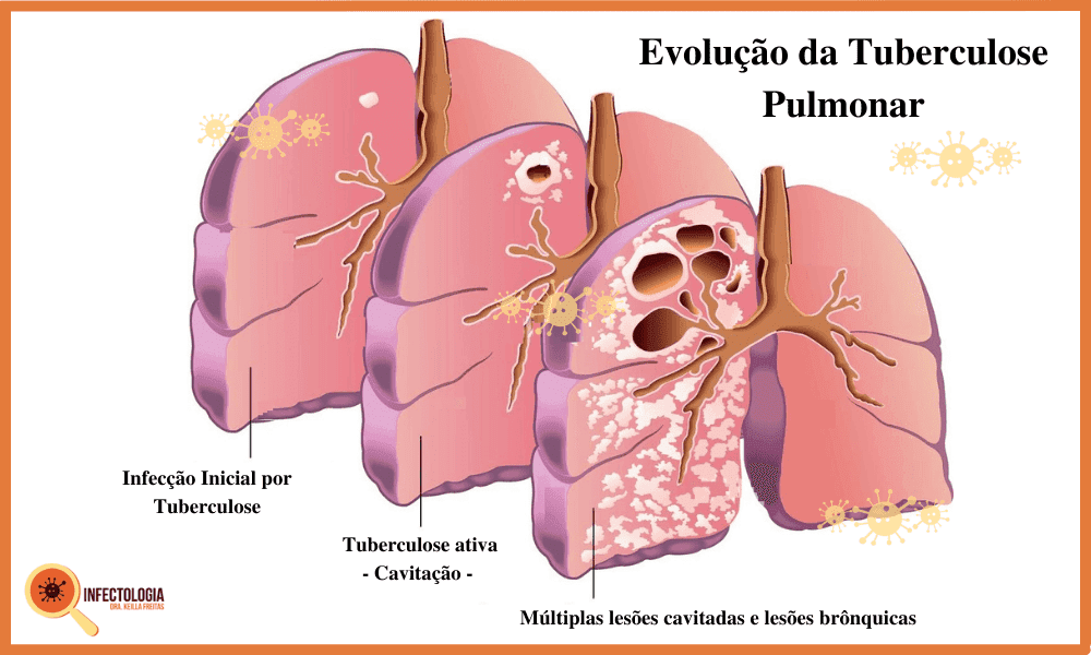 Tuberculose