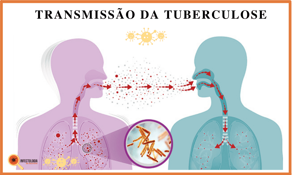 Tuberculose