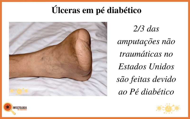 Pé diabético: Conheça